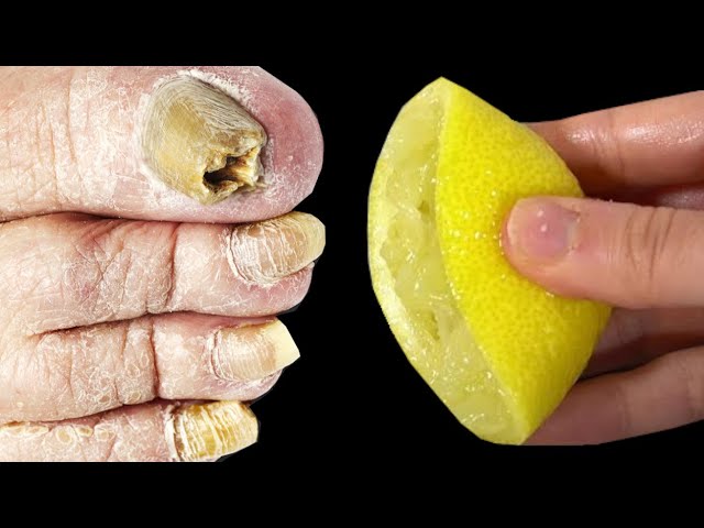 Say Goodbye to Nail Fungus with this Quick DIY Solution!