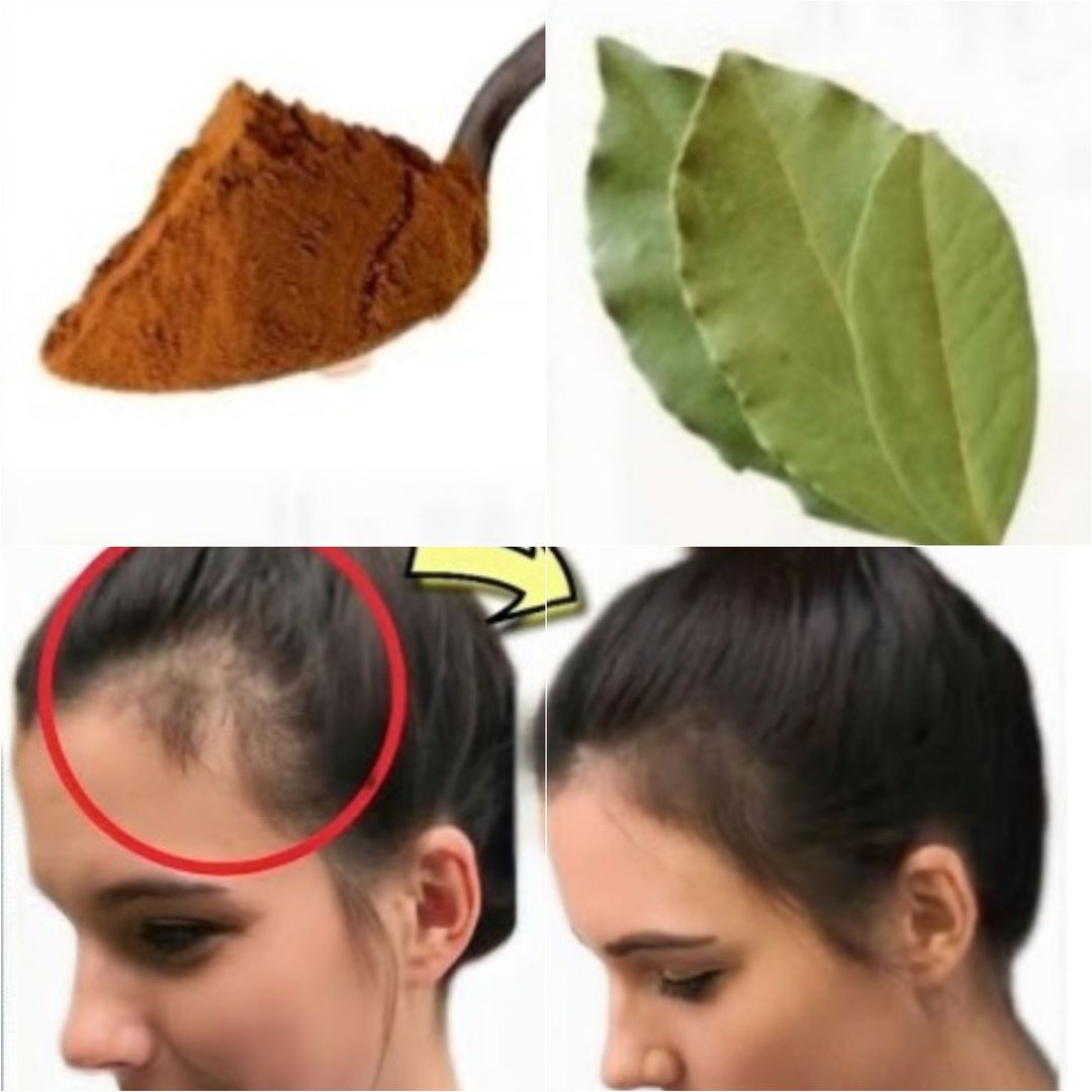 Natural Remedies for Hair Loss and Growth in Balding Areas