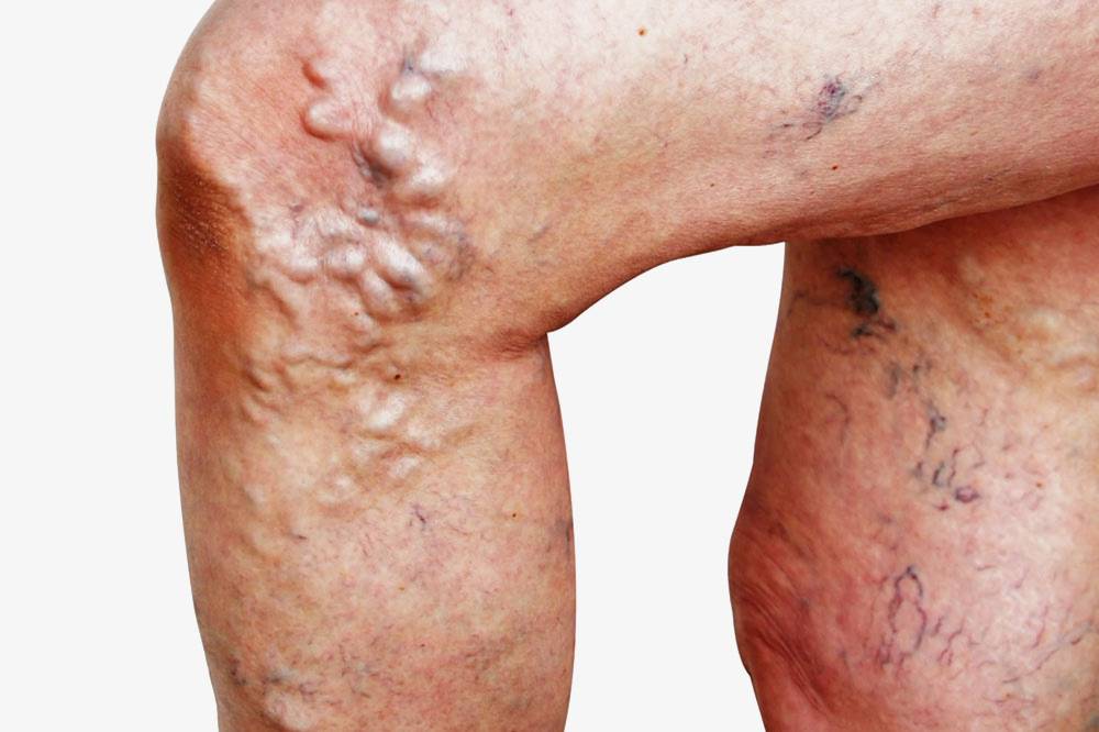 Discover the Extraordinary Natural Remedy for Varicose Veins: Pycnogenol