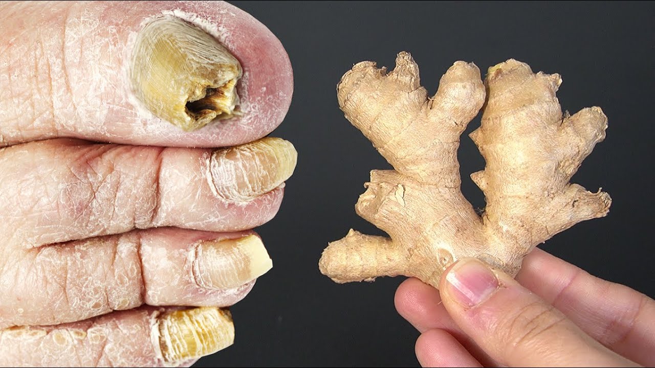 A Friendly Guide to Using Ginger for Toe Fungus