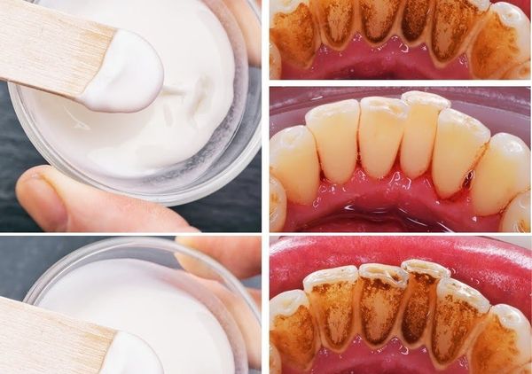 Discovering Baking Soda’s Potential for a Better Mouth and Teeth