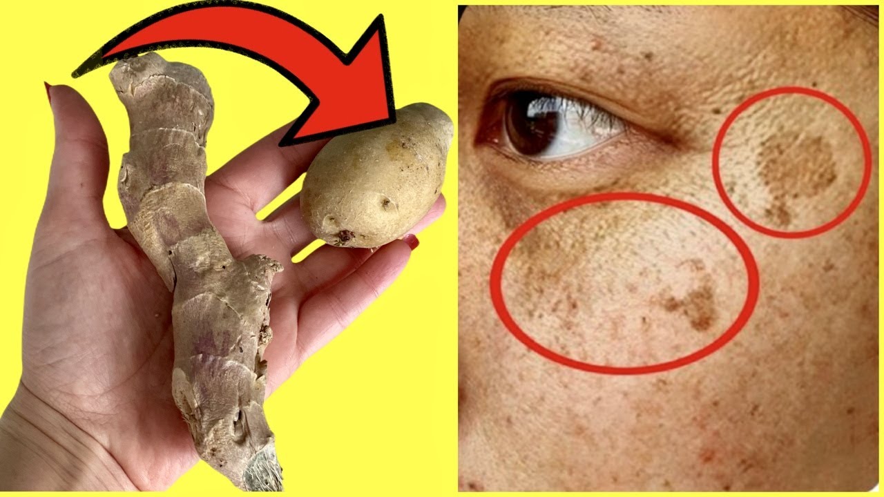 The Natural Wonder: Erasing Dark Spots with Potatoes and Ginger