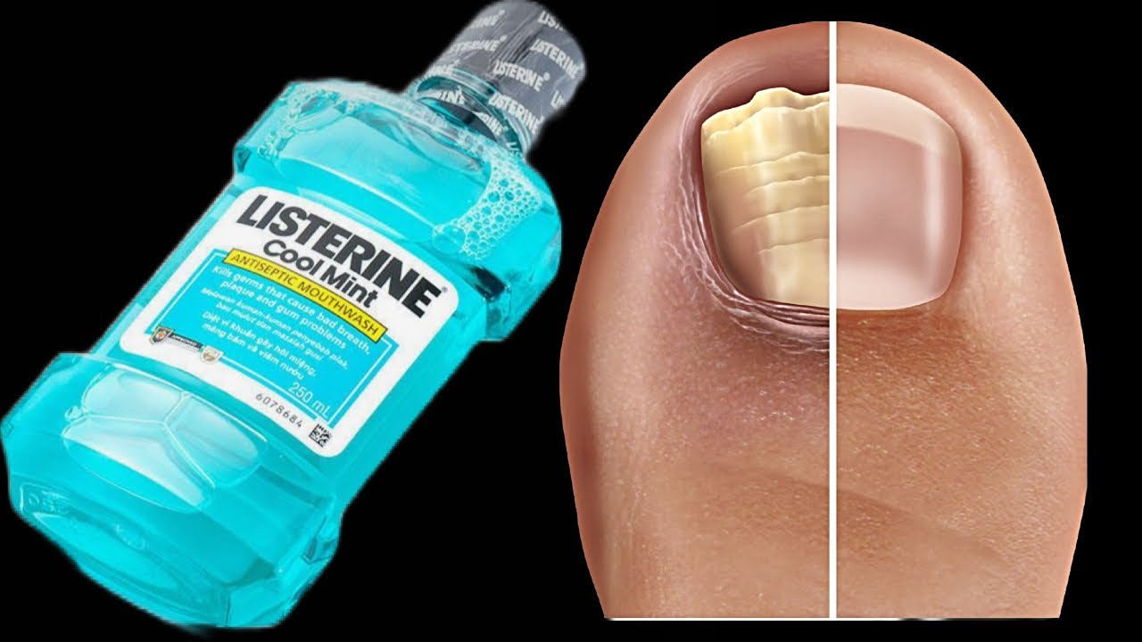 Wave Goodbye to Nail Fungus with This Surprisingly Simple Mouthwash Recipe