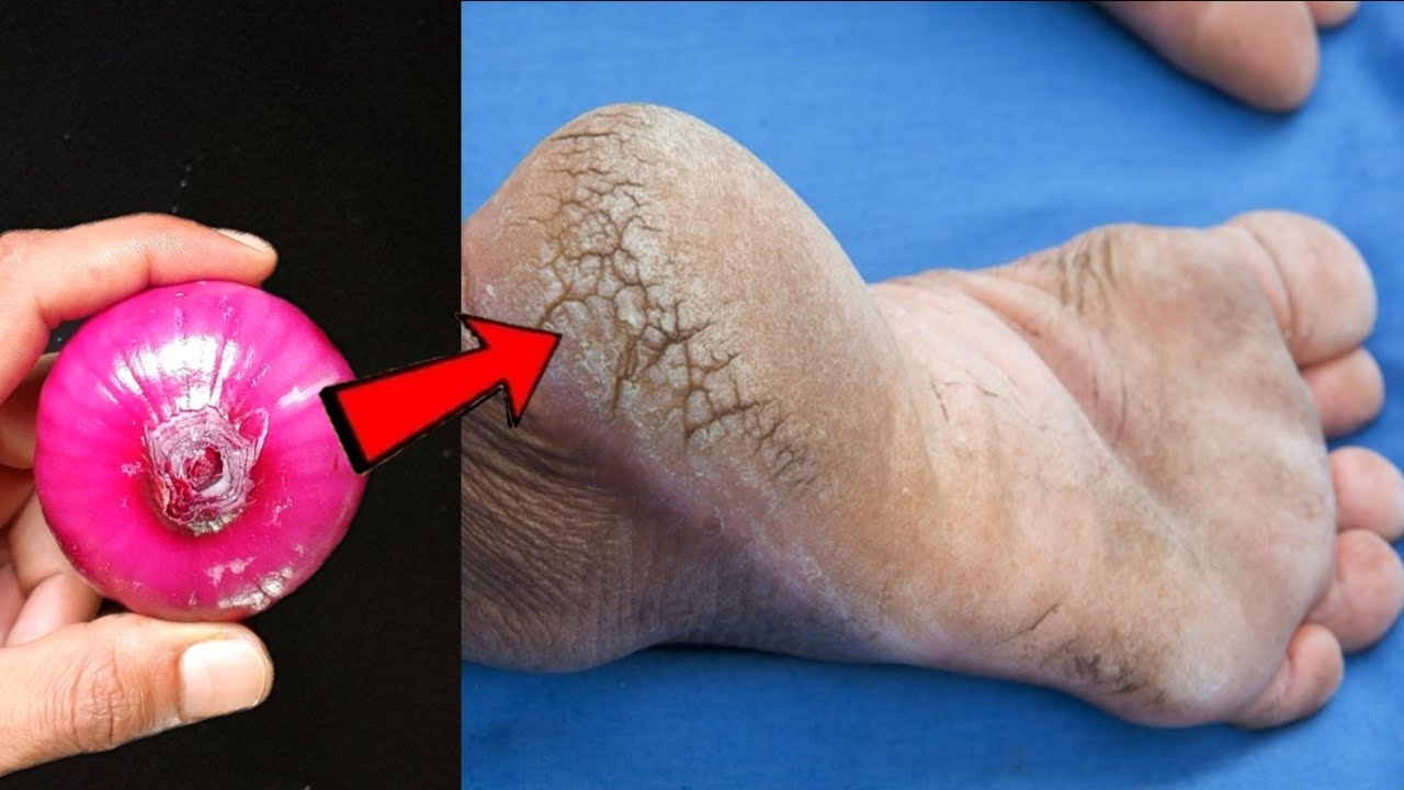 Say Goodbye to Cracked Heels with This Magical Onion Remedy