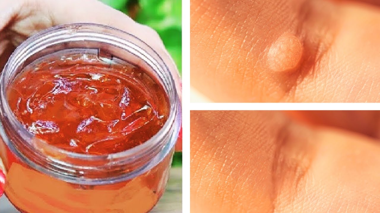 The Secret Weapon Against Warts: A Simple, Natural Solution