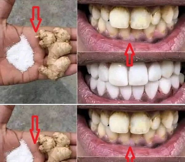 The Best Method for Teeth Whitening: Ginger and Salt