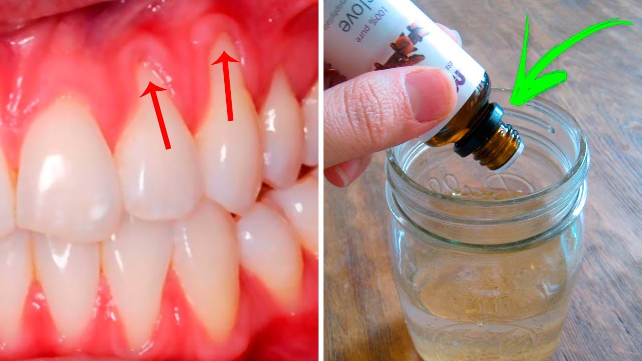 Natural Remedies for Receding Gums: Three Easy and Effective Methods