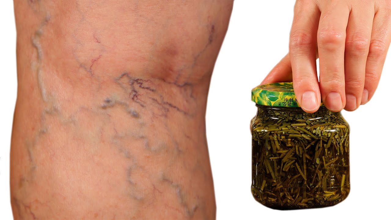 The Rosemary Revolution: A Natural Solution for Varicose Veins