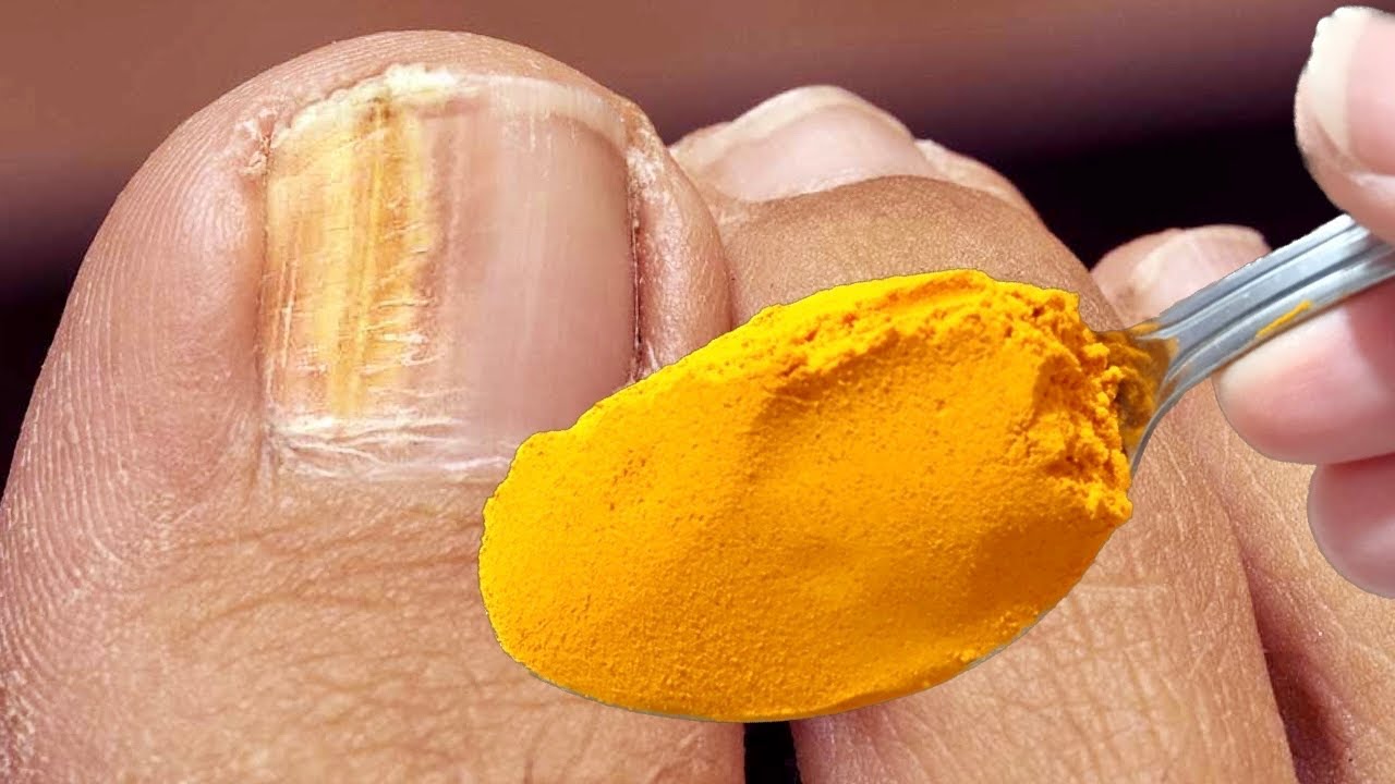 Say Goodbye to Toenail Fungus with the Power of Turmeric: A Natural and Effective Treatment