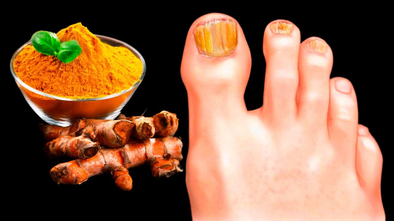 Triumph Over Nail Fungus: The Mighty Power of Turmeric