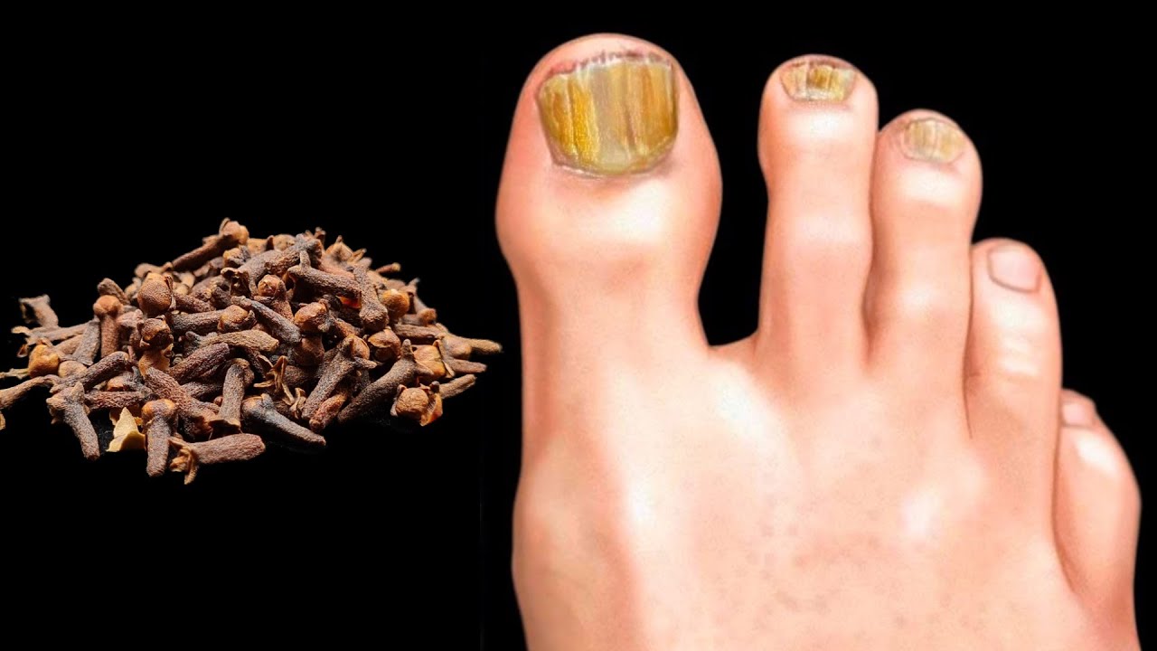 Bye-Bye Nail Fungus: The Power of Cloves as a Remedy