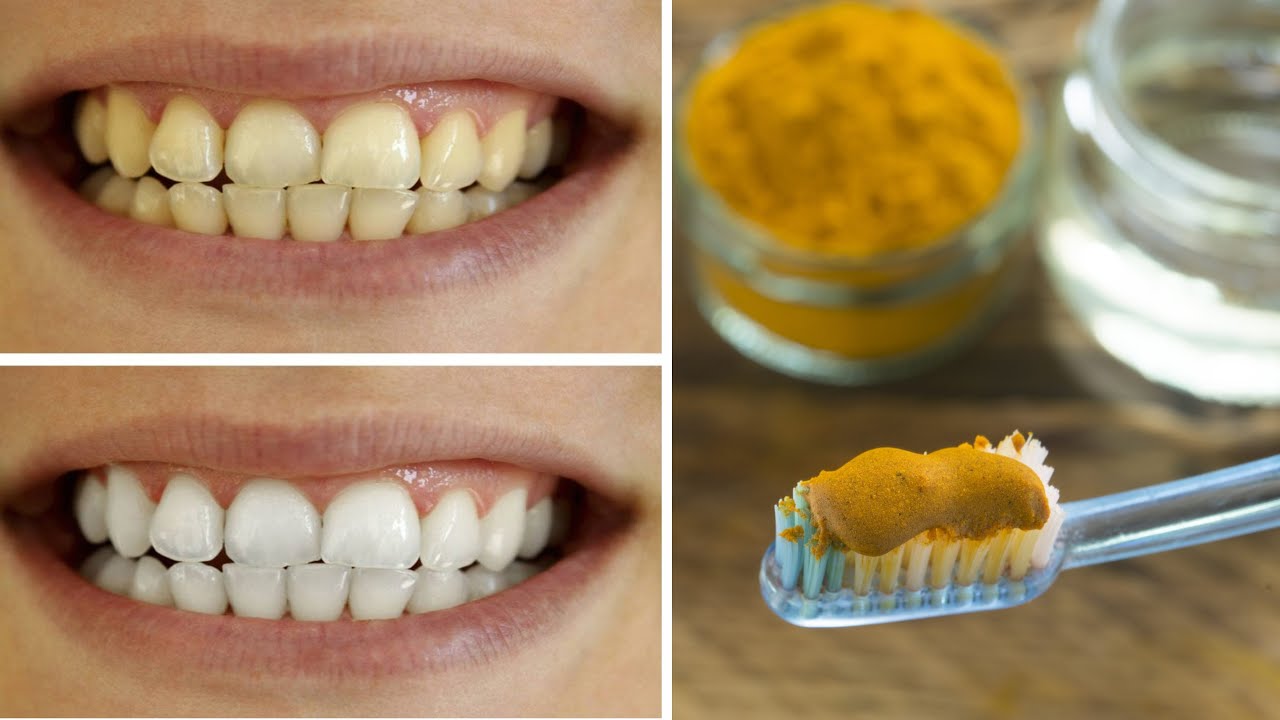 Unlocking a Brighter Smile with Turmeric: A Natural Approach