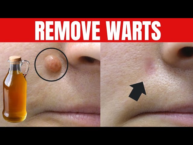 Saying Goodbye to Warts: The Magic of Apple Cider Vinegar