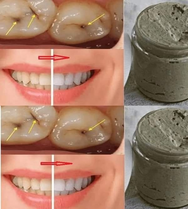 Make Your Own Natural Toothpaste for a Beautiful Smile